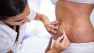 Liposuction or Coolsculpting: Which Works for Your Body?