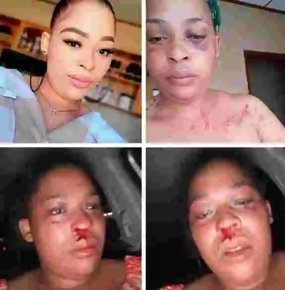 I Need Justice - South African Woman Says After She Was Brutalized By Her Police Officer Boyfriend